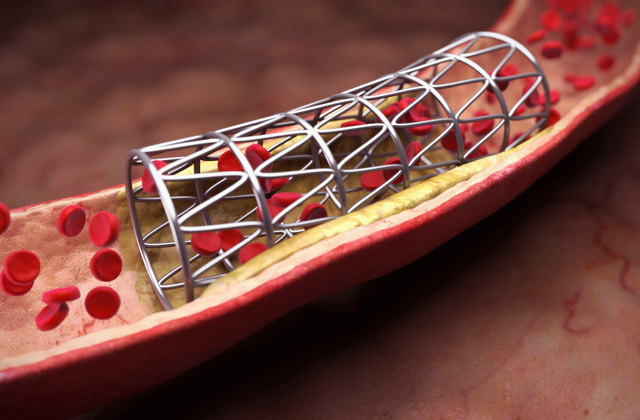 В кардиохирургию активно входят 3D-технологии