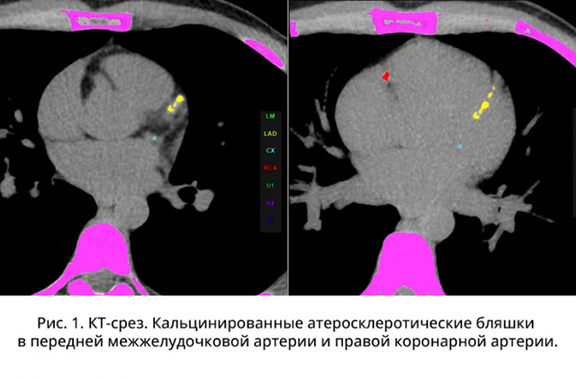 Обнаружены новые дефекты в генах, отвечающих за развитие семейной гиперхолестеринемии